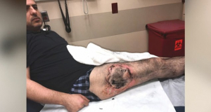 Man has third-degree burn on leg after vape battery explodes