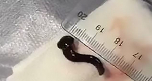 Doctors find 3cm-long leech in throat of woman