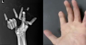 Хирурги смогли восстановить руку, которую разорвало на три части после инцидента на производстве (фото)