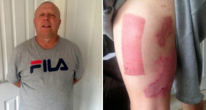 Man receives third-degree burns after vape blasts in his pocket
