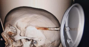 Врачи удалили застрявшую в черепе женщины крышку от скороварки (фото)