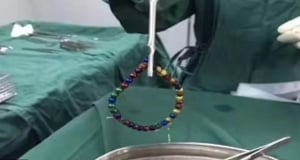 Хирурги извлекли из кишечника годовалого малыша «бусы» из магнитных шариков