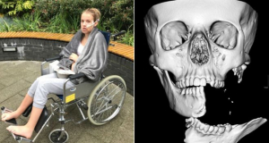 Британский хирург восстановил 15-летней девушке оторванную в результате падения с лошади челюсть