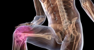 Osteoarthritis medications can cause unwanted side effects, specialist says