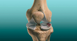 Уникальный имплантат сможет заменить поврежденный мениск в колене
