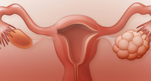 Polycystic ovary syndrome: Women inherited it more often that we thought