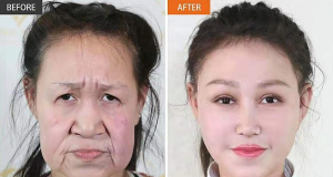 Teen, 15, looking decades older, gets new face
