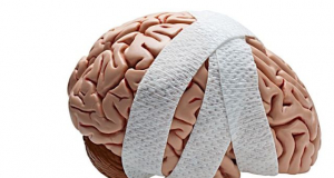 Сотрясения мозга на 72% повышают риск старческого слабоумия