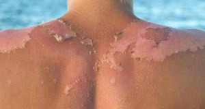 What should not be done in case of sunburn?