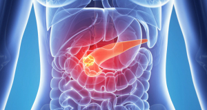 What are the first signs you can suspect pancreatic cancer?
