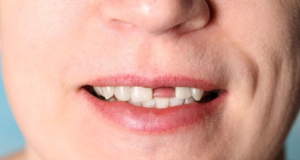 На какое заболевание может указывать выпадение зубов?