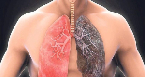 Ինչպե՞ս կանխել թոքերի քրոնիկ օբստրուկտիվ հիվանդության զարգացումը
