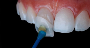 Как виниры влияют на здоровье зубов?