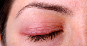 What disease could an itchy eyelid indicate?