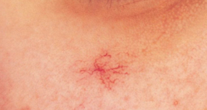 What diseases can spider veins indicate?