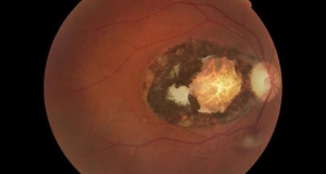 Ученые выявили в Австралии высокий уровень заболеваемости токсоплазмозом, чреватым потерей зрения