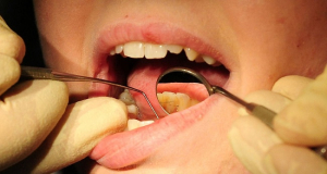 Բերանի խոռոչի ո՞ր տագնապալի նշանները կարող են վկայել մահացու հիվանդության մասին