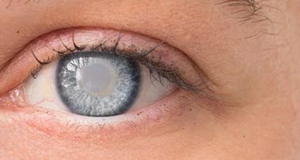 Ученые предложили новый метод лечения катаракты без хирургического вмешательства