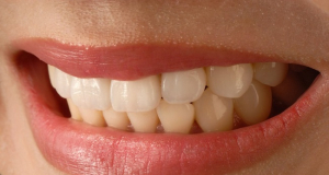 Popular myths about dental implants debunked