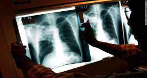 Несколько важных фактов о туберкулезе