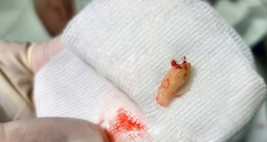 Իրկուտսկում բժիշկներն ատամ են հեռացրել 14-ամյա աղջկա քթից
