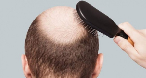 О риске развития какой опасной болезни предупреждает выпадение волос у молодых мужчин?