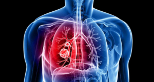 Որ ախտանիշներն են վկայում թոքերի քաղցկեղի մասին