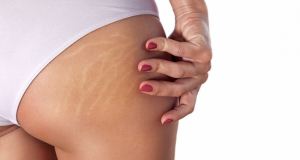 How to get rid of unwanted cellulite forever?