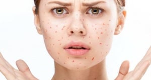 What diseases can be caused by pimples on face?