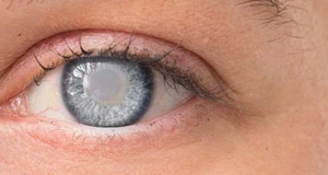 Գիտնականները աչքի կաթիլներ են մշակում կատարակտի բուժման համար