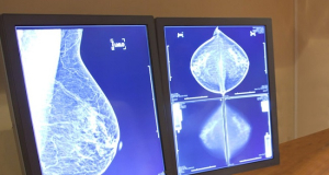 Какую роль играет дополнительная радиотерапия при лечении рака молочной железы?