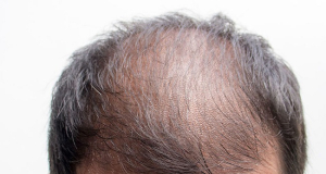 World's first baldness drug approved for use
