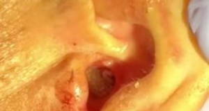 Врачи обнаружили в ухе пациента сотни шевелящихся личинок
