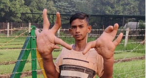 Teenager from India grows 60-centimeter long hands
