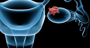 New sign of deadly female cancer found