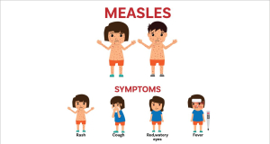 Number of measles cases climb to 50 in Armenia, 3 hospitalized