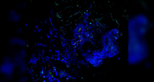 NIH researchers discover new autoinflammatory disease - LAVLI