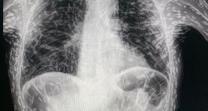 Horror as scan reveals tapeworm infestation in lungs of coughing patient