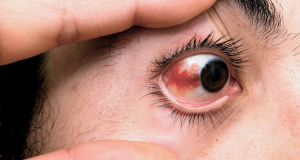 Покраснение глаз может быть признаком высокого кровяного давления
