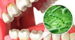 Dentists identify new bacterial species involved in tooth decay