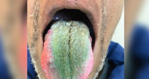 Man's tongue turns green and hairy from cigarettes and antibiotics