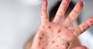 Politico: ВОЗ призвала к проведению «срочных» кампаний по иммунизации из-за ростa заболеваемости корью