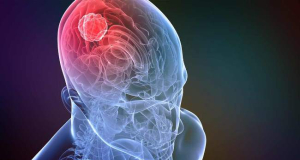Ученые выяснили, почему в некоторых случаях у больных раком пациентов развивается потеря памяти