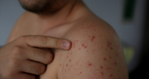WHO: Measles cases rose 79% globally last year
