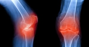Анализ крови способен спрогнозировать развитие остеоартрита за 8 лет до его обнаружения на рентгеновских снимках  - исследование