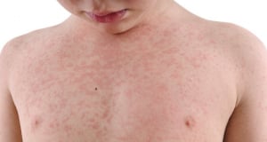 Ministry of Health of Armenia: Laboratory-confirmed measles cases increased by 27 compared to the previous week
