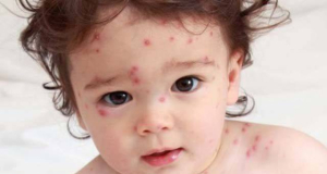 452 cases of measles recorded in Armenia so far in 2024