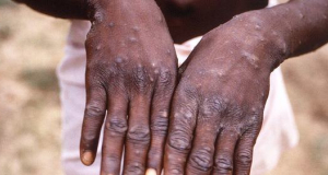 Monkeypox outbreak detected in South Africa: one person died