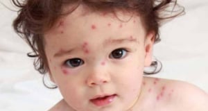 472 cases of measles recorded in Armenia so far in 2024