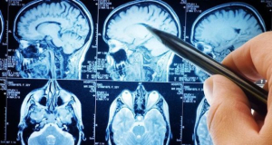 В России создали краситель для визуализации опухоли головного мозга при операции